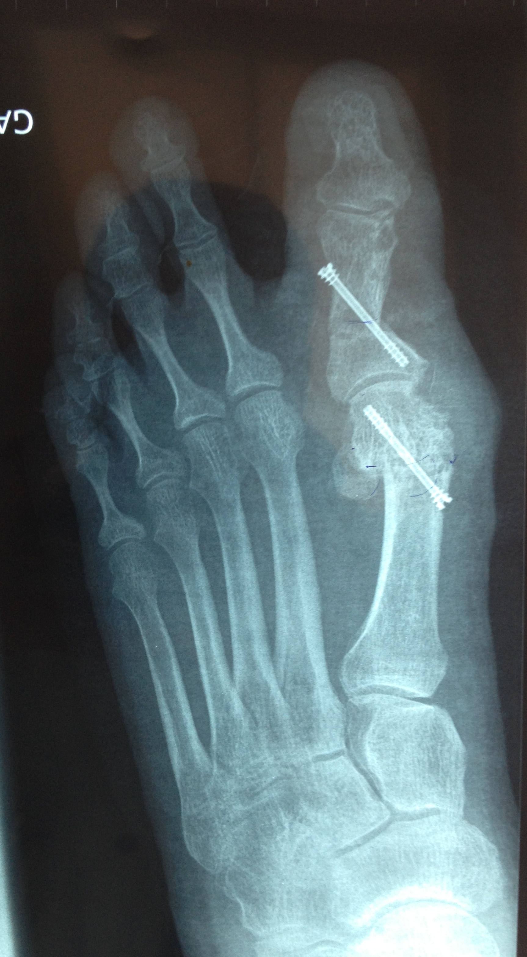 Hallux valgus Dr LEFEBVRE Benjamin