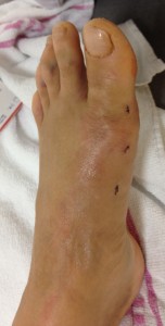 Plantar Fasciitis,Pes Planus,Mallet Toe,High Arched Feet,Heel Spur,Heel Pain,Hammer Toe,Hallux Valgus,Foot Pain,Foot Hard Skin,Foot Conditions,Foot Callous,Flat Feet,Fallen Arches,Diabetic Foot,Contracted Toe,Claw Toe,Bunions Hard Skin,Bunions Callous,Bunion Pain,Ball Of Foot Pain,Back Pain