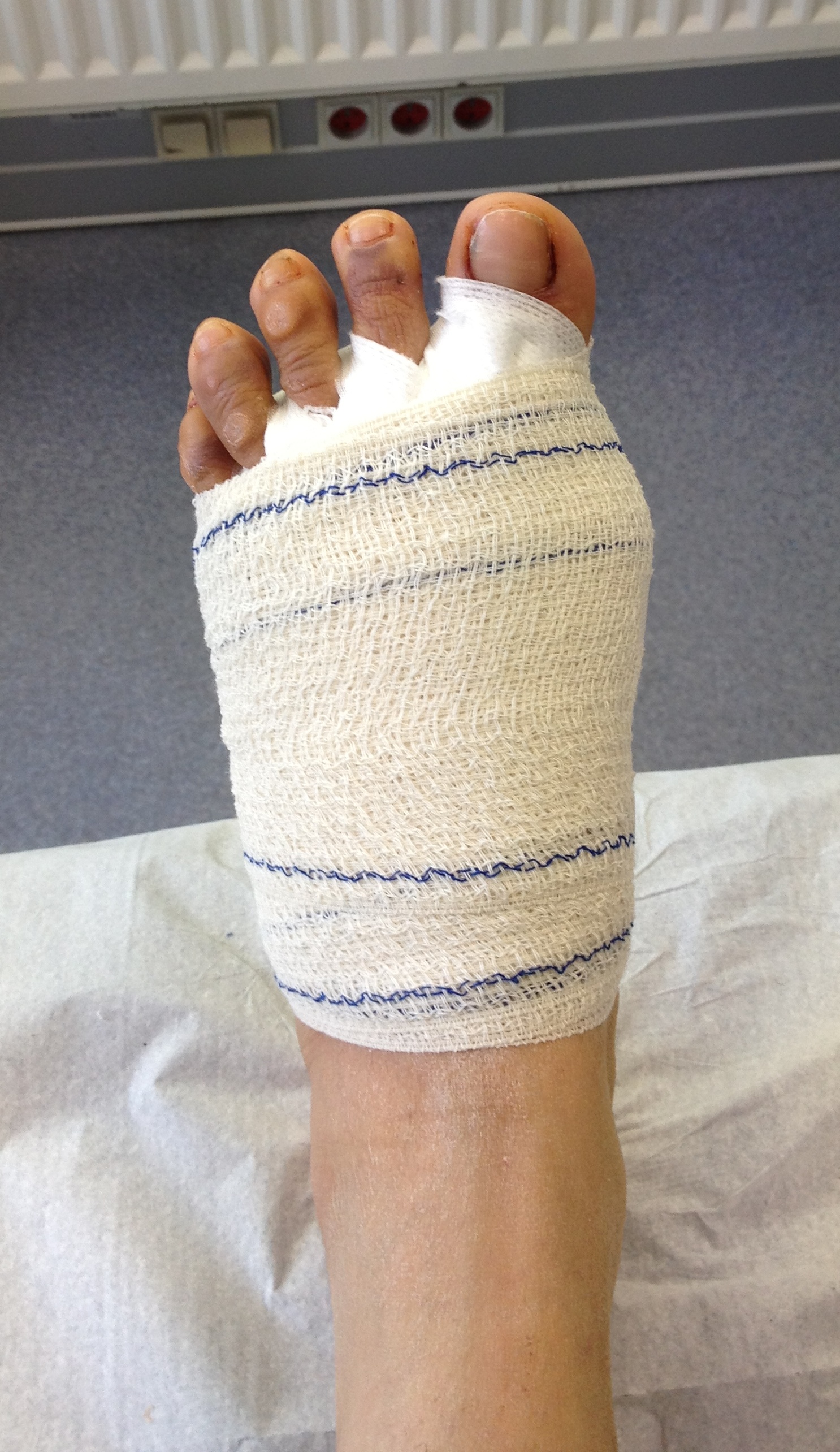 Hallux valgus Dr LEFEBVRE Benjamin