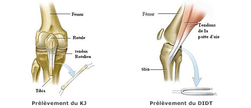 Lésions ligamentaires des croisés | Dr LEFEBVRE Benjamin