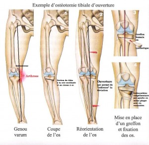 osteotomie