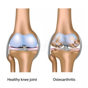 arthrose genou schema