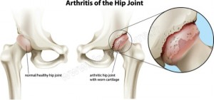 arthrose hanche schema