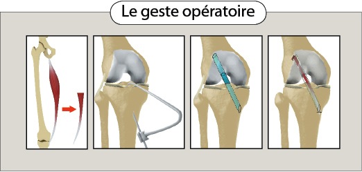 Lésions ligamentaires des croisés | Dr LEFEBVRE Benjamin