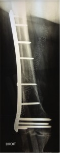 femur rx