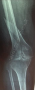 femur rx2