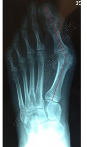 hallux rx