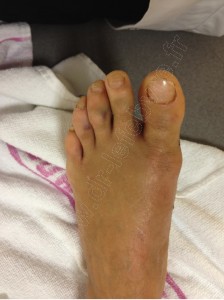 hallux valgus peau