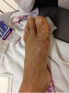 hallux valgus peau2