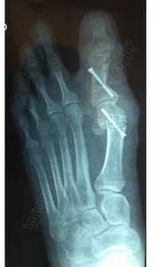 hallux valgus rx