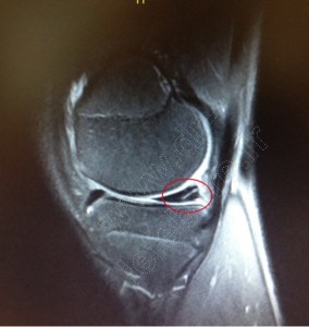 irm menisque lesion horizontale