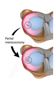 meniscectomie schema