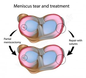 menisque schema