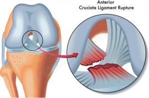 rupture lca schema