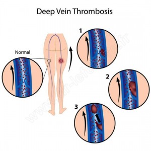 thrombose veineuse