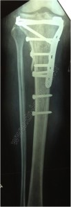 tibia rx