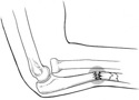 fracture de l'ulna avec luxation de la tête radiale (fracture de Monteggia)