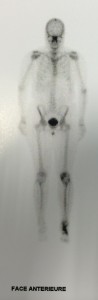 scintigraphie osseuse montrant une fixation en regard du genougauche