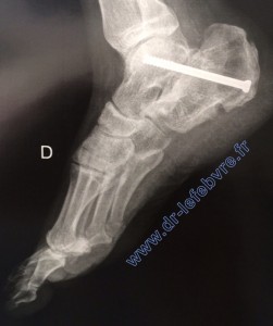 Radiographie de profil du pied montrant l'arthrodèse sous-talienne.