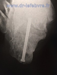 Radiographie du talon montrant l'arthrodèse sous-talienne maintenue par une vis.