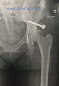 Radiographie post-opératoire de la butée mise en place reconstituant la couverture de la tête fémorale.