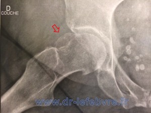 Radiographie de profil de la hanche exposant la butée osseuse responsable du conflit fémoro-acétabulaire.