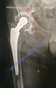 Radiographie d'une prothèse totale de hanche montrant un descellement de cotyle par verticalisation de ce dernier.