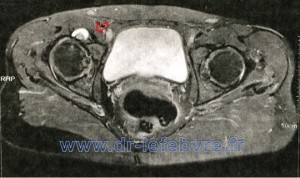 Coupe coronale d'IRM montrant un kyste à la face antérieure du col fémoral responsable de douleurs.