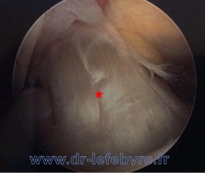 Image arthroscopique du ligament croisé antérieur normal.