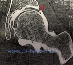 Coupe frontale d'arthro-scanner montrant en contraste la lésion du bourreler.