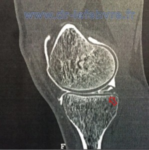 Arthroscanner injecté du genou montrant en contraste la lésion méniscale du segment postérieur.