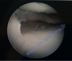 Image arthroscopie d'une méniscectomie partielle.