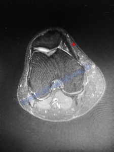 Coupe d'IRM coronale du genou post-opératoire montrant la présence de la ligamentoplastie qui limite la latéralisation de la rotule pour une meilleure stabilité.