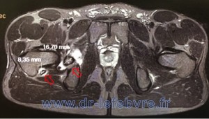 IRM de hanche en coupe coronale montrant les corps étrangers intra-articulaires de l'ostéochondromatose.