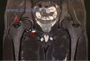 IRM de hanche montrant une ostéochondromatose avec la présence de corps étrangers intra-articulaires.