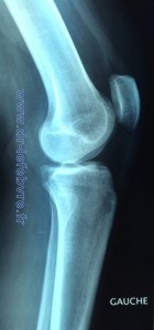 Radiographie de profil du genou montrant une rotule en position haute favorisant l'instabilité rotulienne.