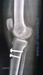 Radiographie de profil du genou montrant le bon positionnement de la rotule par abaissement de la tubérosité tibiale antérieure.