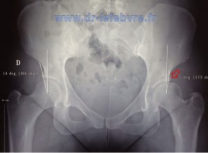 Radiographie du bassin montrant le défaut de couverture la hanche gauche expliquant la symptomatologie et l'indication d'une butée pour recouvrir la tête fémorale.