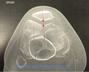 Coupe coronale du scanner montrant le bon alignement de la rotule avec le fémur.