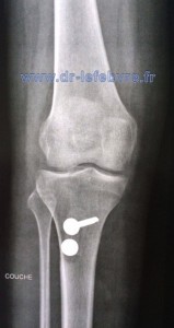 Radiographie de face du genou montrant la médialisation de la tubérosité tibiale antérieure.